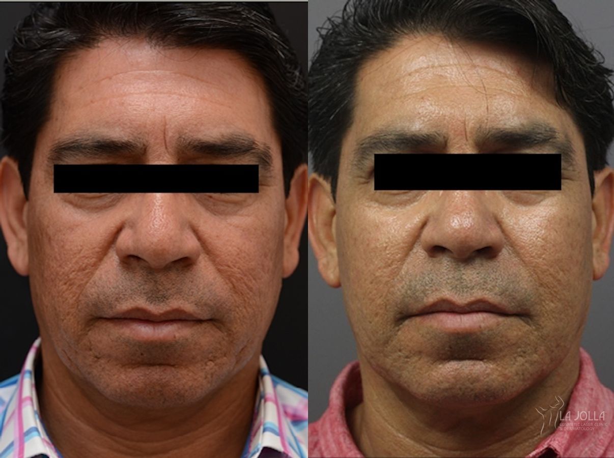 Before and after ResurFX case 36096