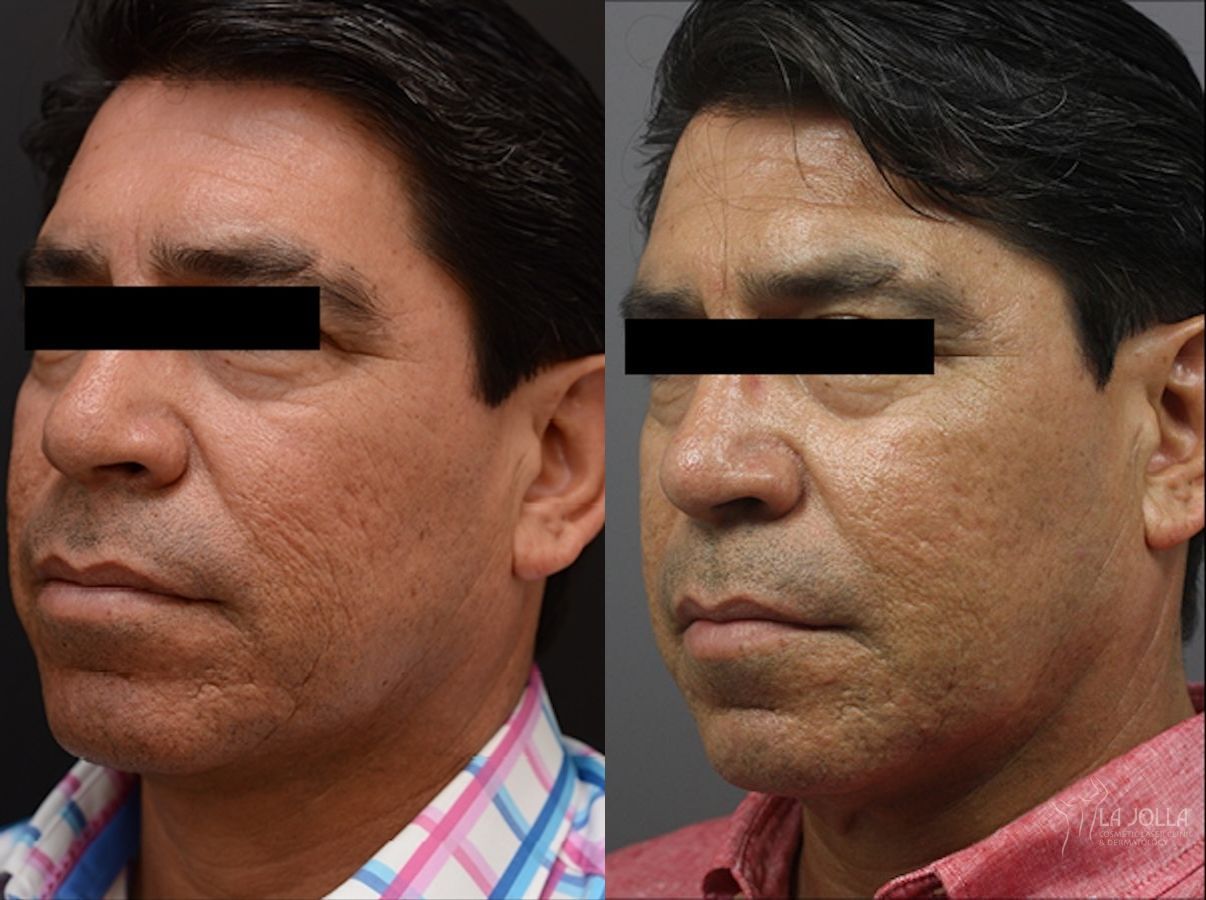 Before and after ResurFX case 36096 - Angle 2