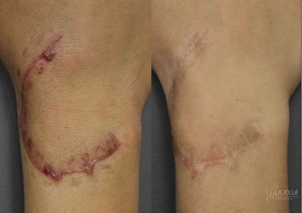 Before and after ResurFX case 36067