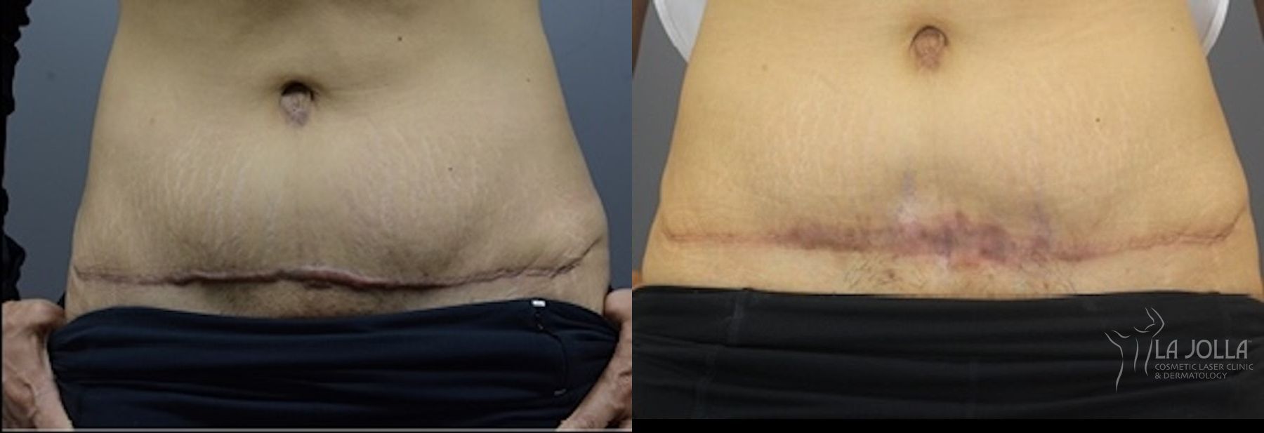 Before and after ResurFX case 36206