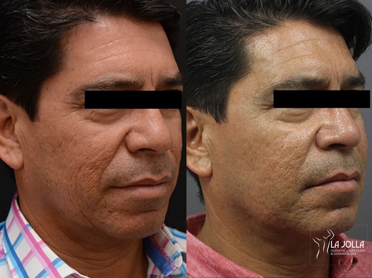 Before and after ResurFX case 36096 - Angle 3