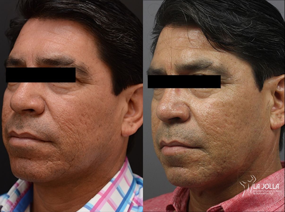 Before and after ResurFX case 36096 - Angle 2