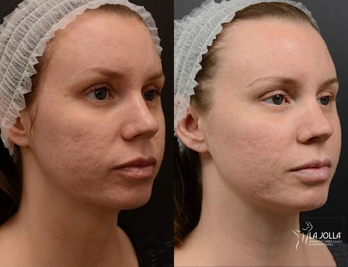 Before and after ResurFX case 36285