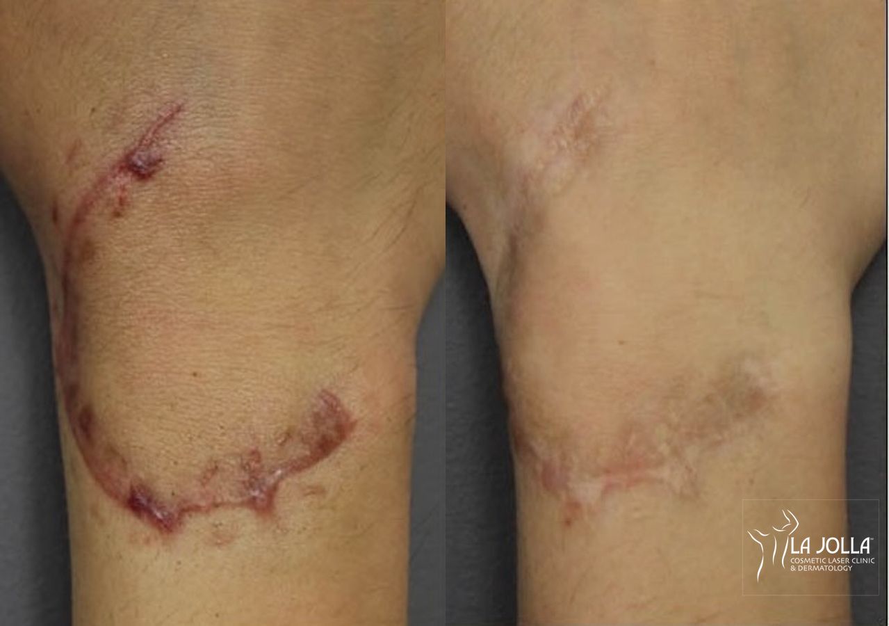 Before and after ResurFX case 36067