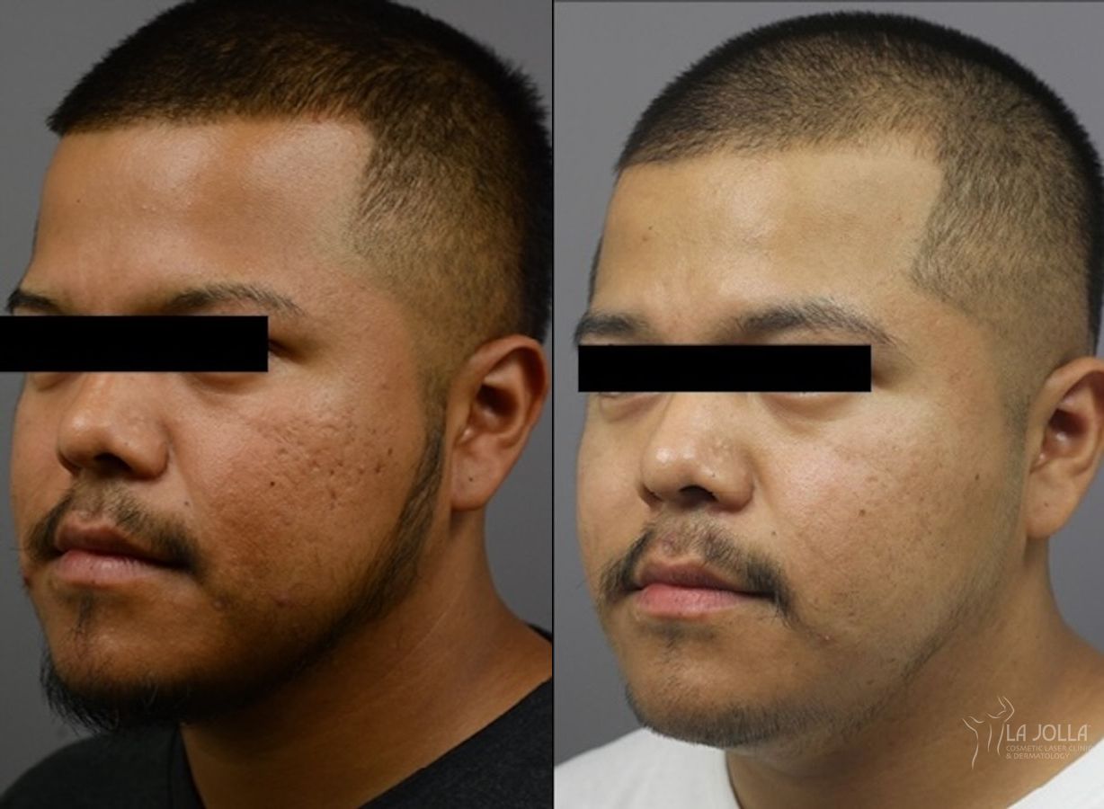 Before and after ResurFX case 36145