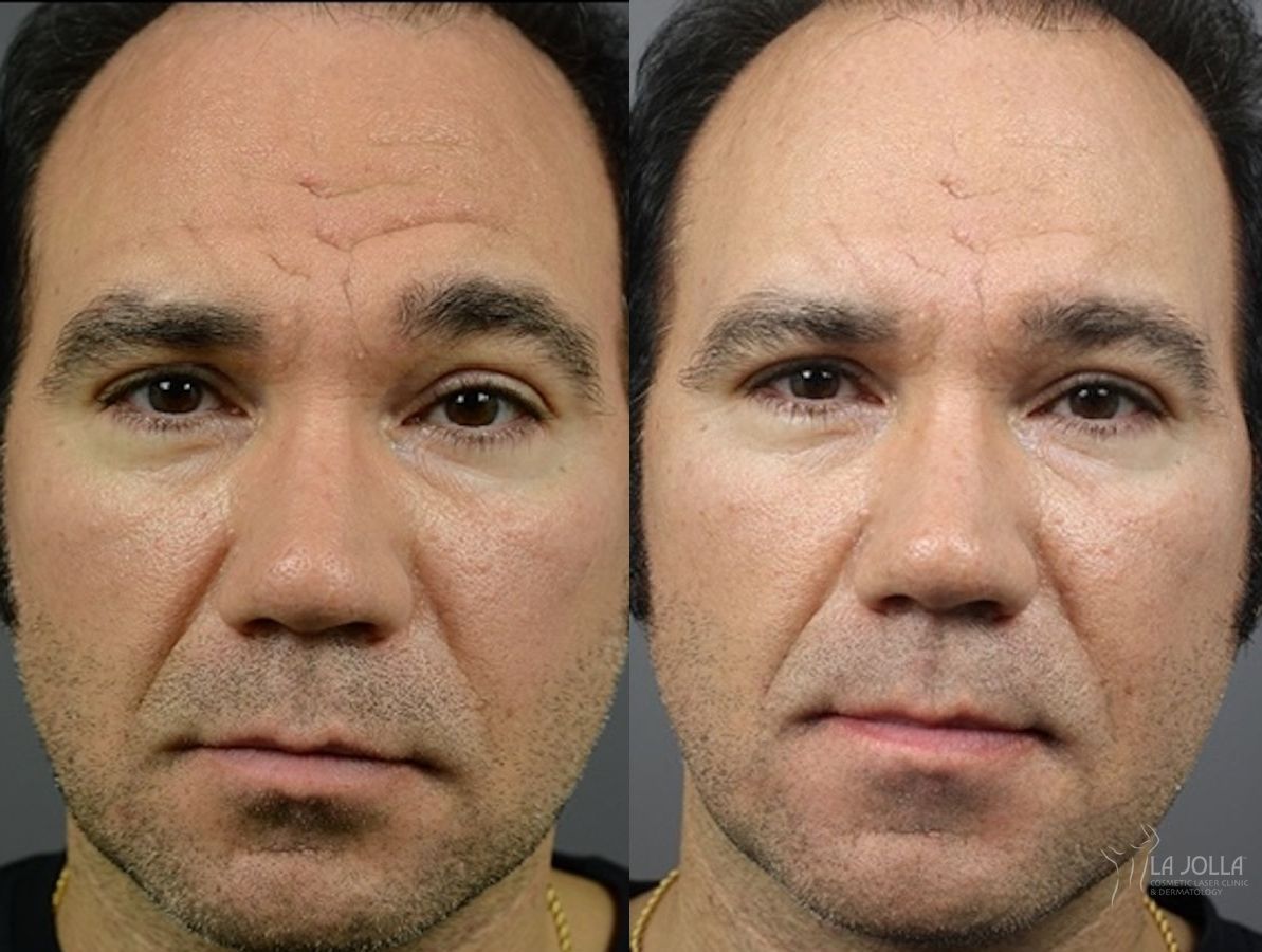 Before and after ResurFX case 36166