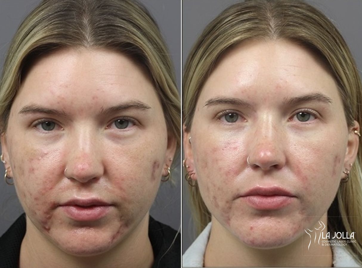 Before and after ResurFX case 36133