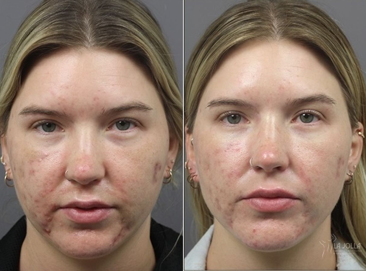 Before and after ResurFX case 36133