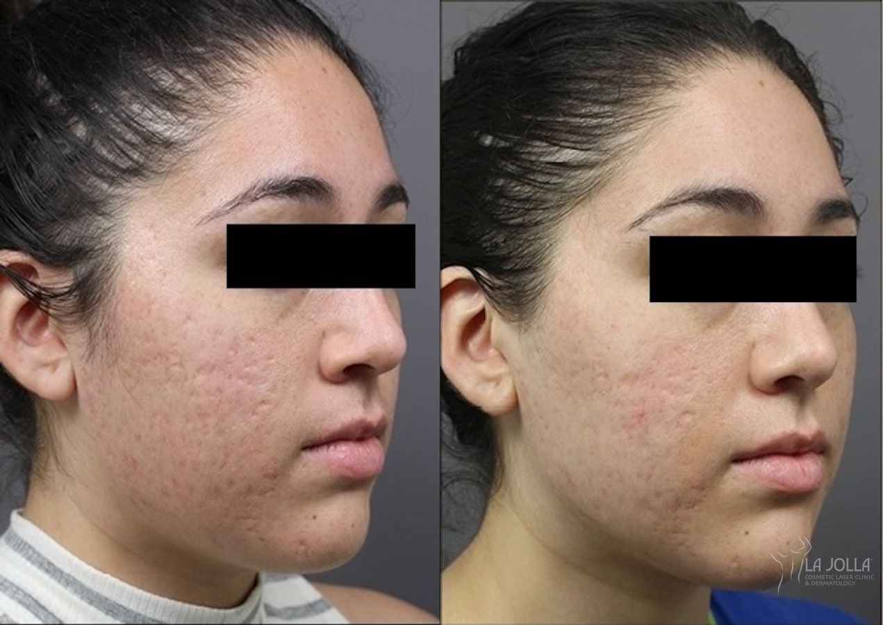 Before and after ResurFX case 36225