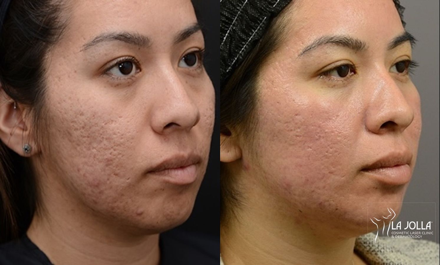 Before and after ResurFX case 36269