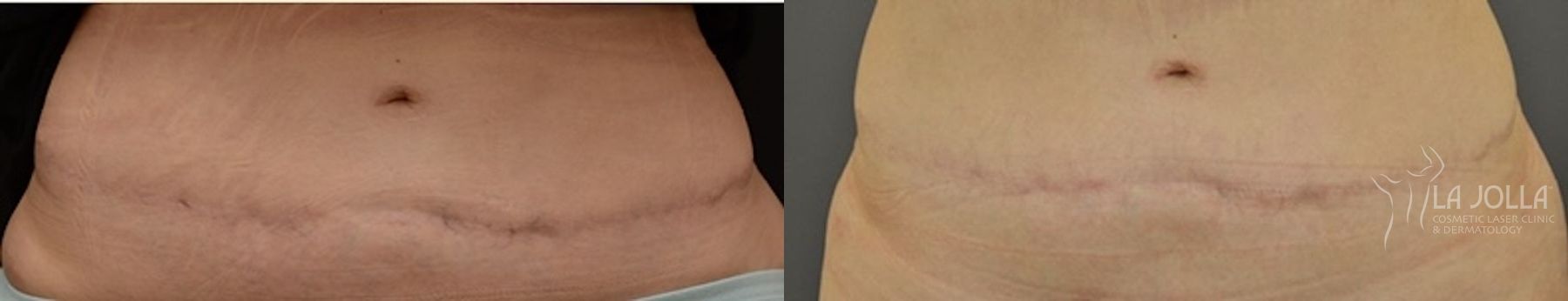 Before and after ResurFX case 36247