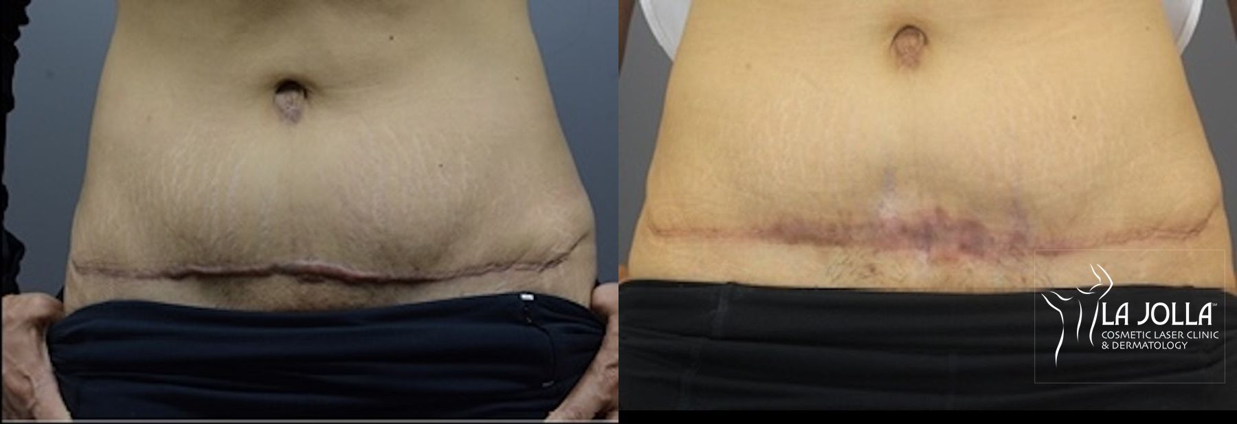 Before and after ResurFX case 36206