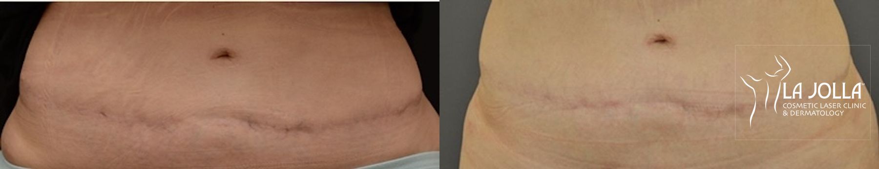 Before and after ResurFX case 36247