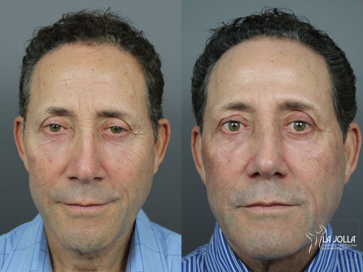 Before and after SP Dynamis case 36327