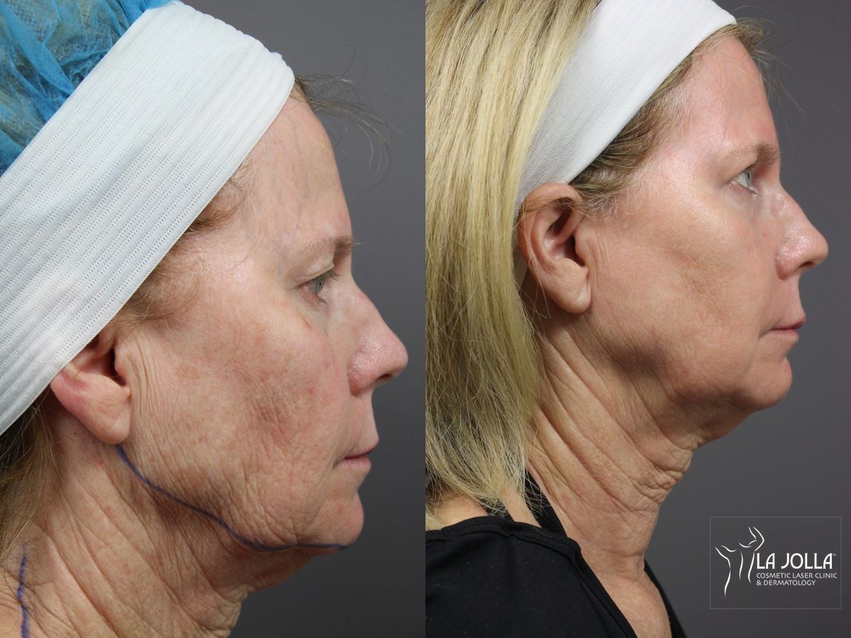 Before and after SP Dynamis case 36372