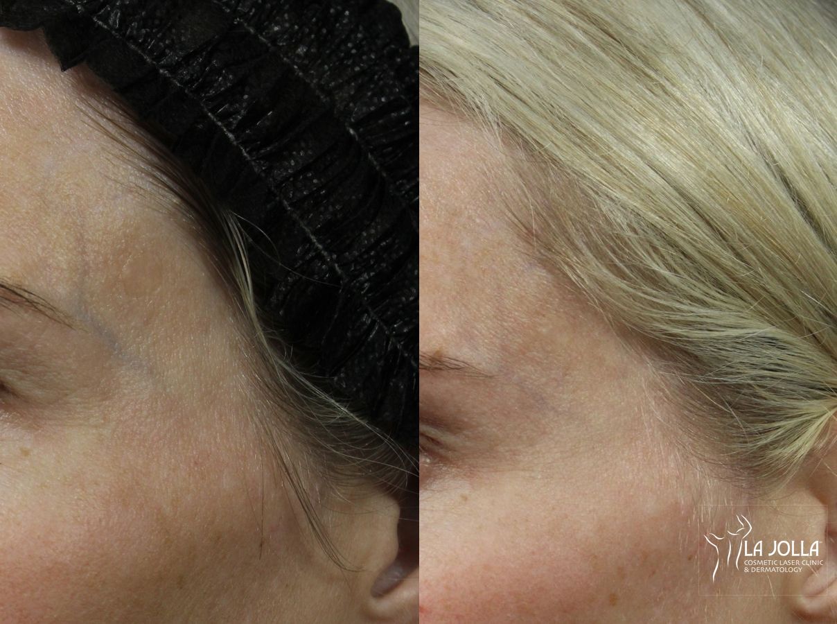 Before and after SP Dynamis case 36069