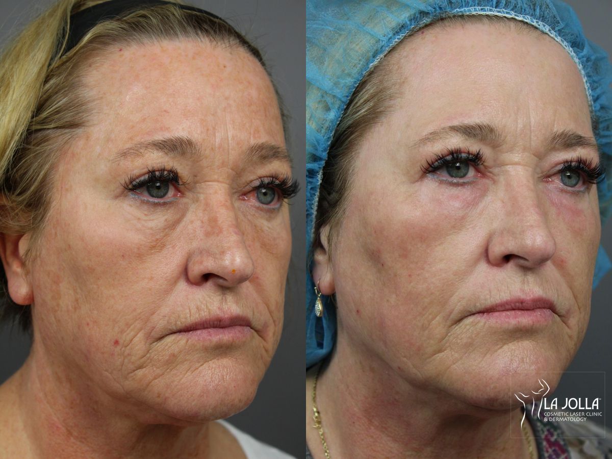 Before and after SP Dynamis case 36338