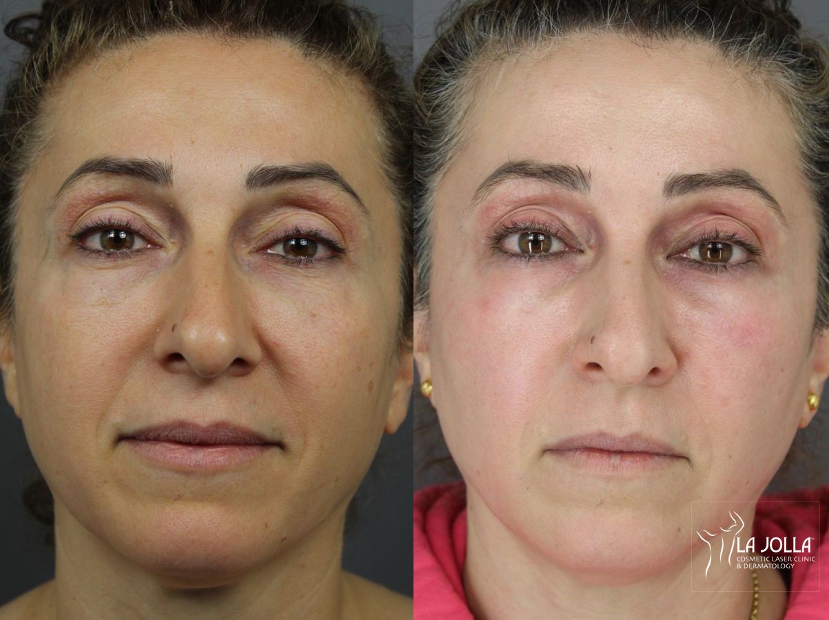 Before and after SP Dynamis case 36376