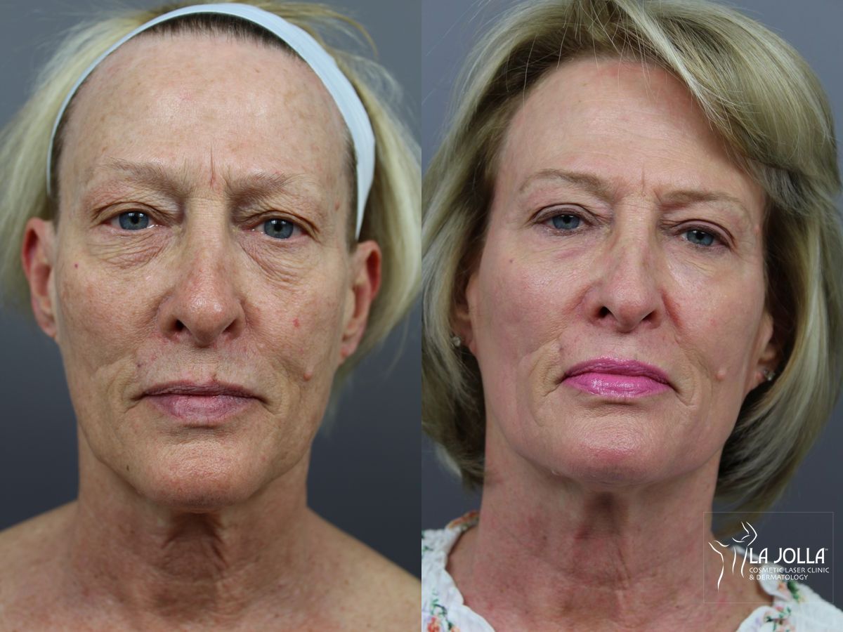 Before and after SP Dynamis case 36348