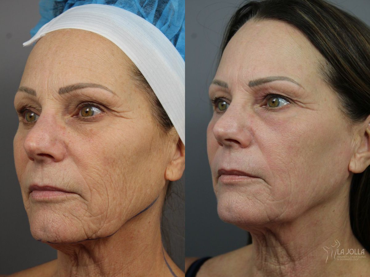 Before and after SP Dynamis case 36355