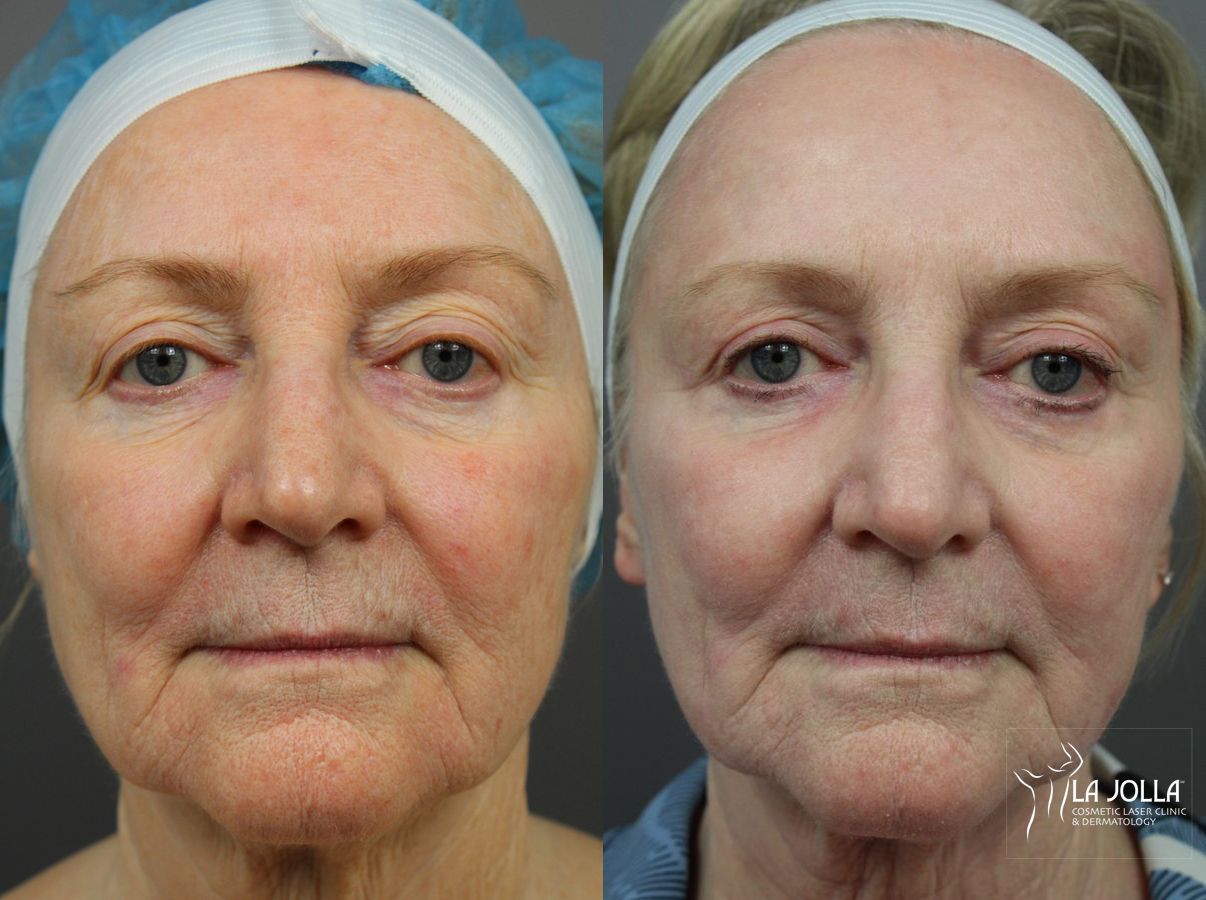 Before and after SP Dynamis case 36262 - Angle 2