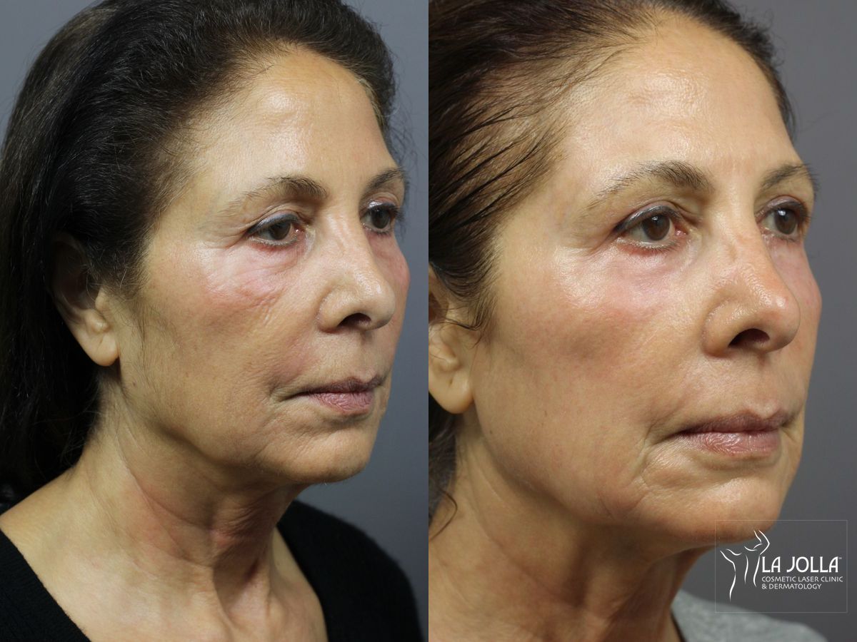 Before and after SP Dynamis case 36362