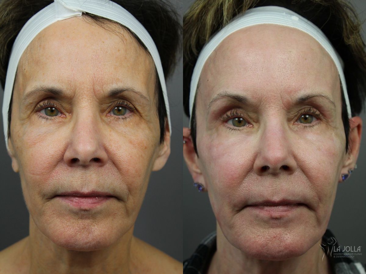 Before and after SP Dynamis case 36360