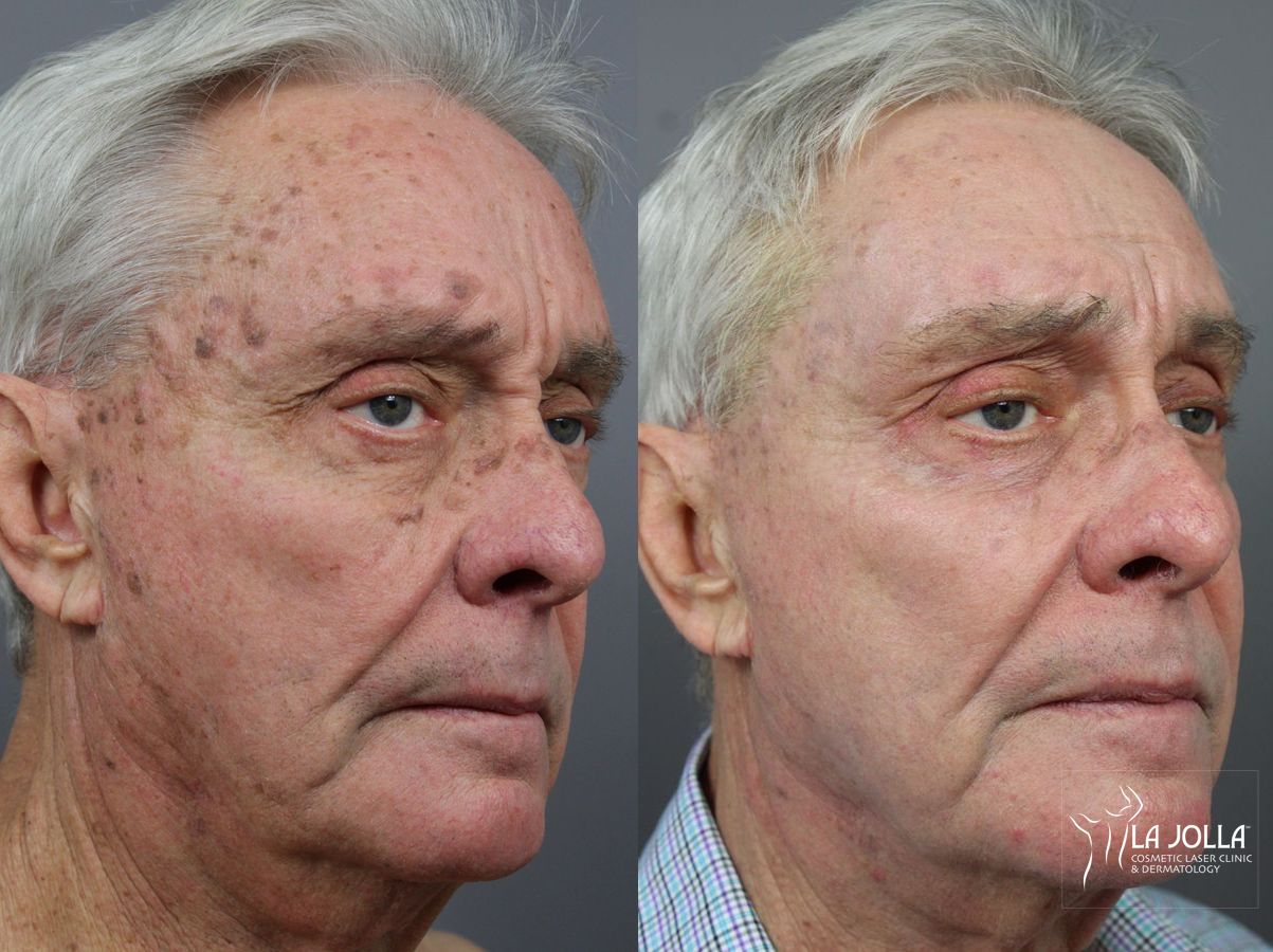 Before and after SP Dynamis case 36115 - Angle 2