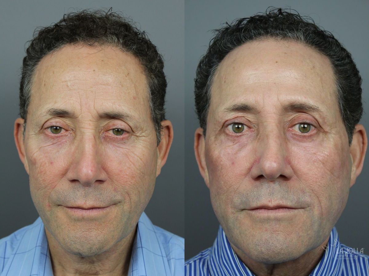 Before and after SP Dynamis case 36327