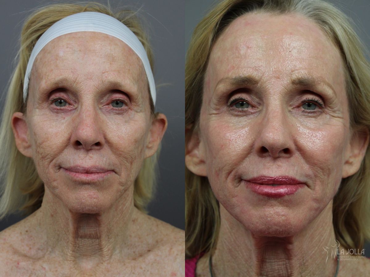 Before and after SP Dynamis case 36378