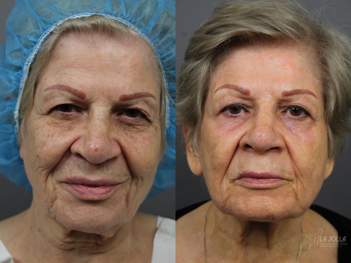 Before and after SP Dynamis case 36365