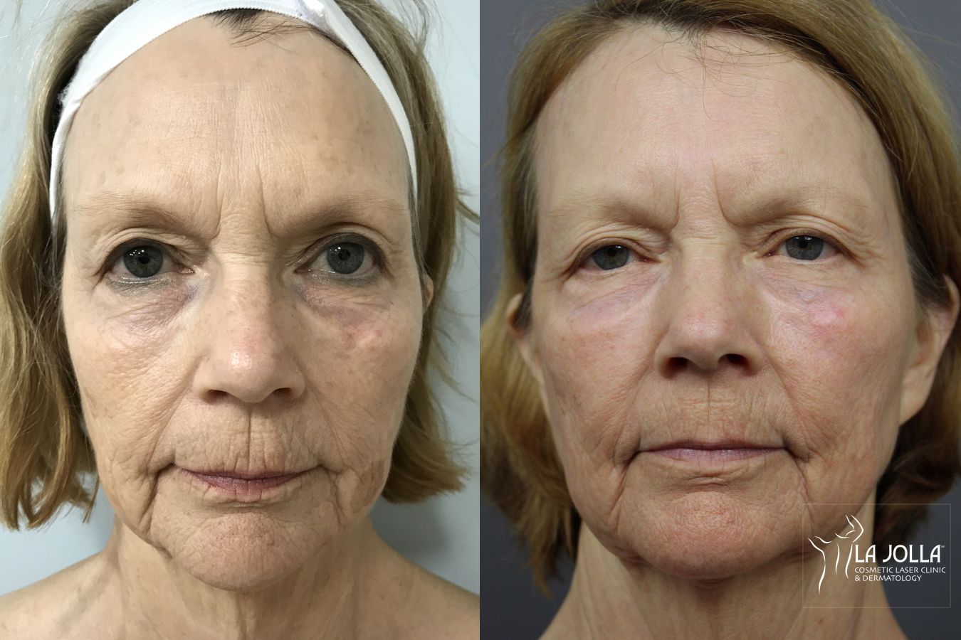 Before and after SP Dynamis case 36202 - Angle 2