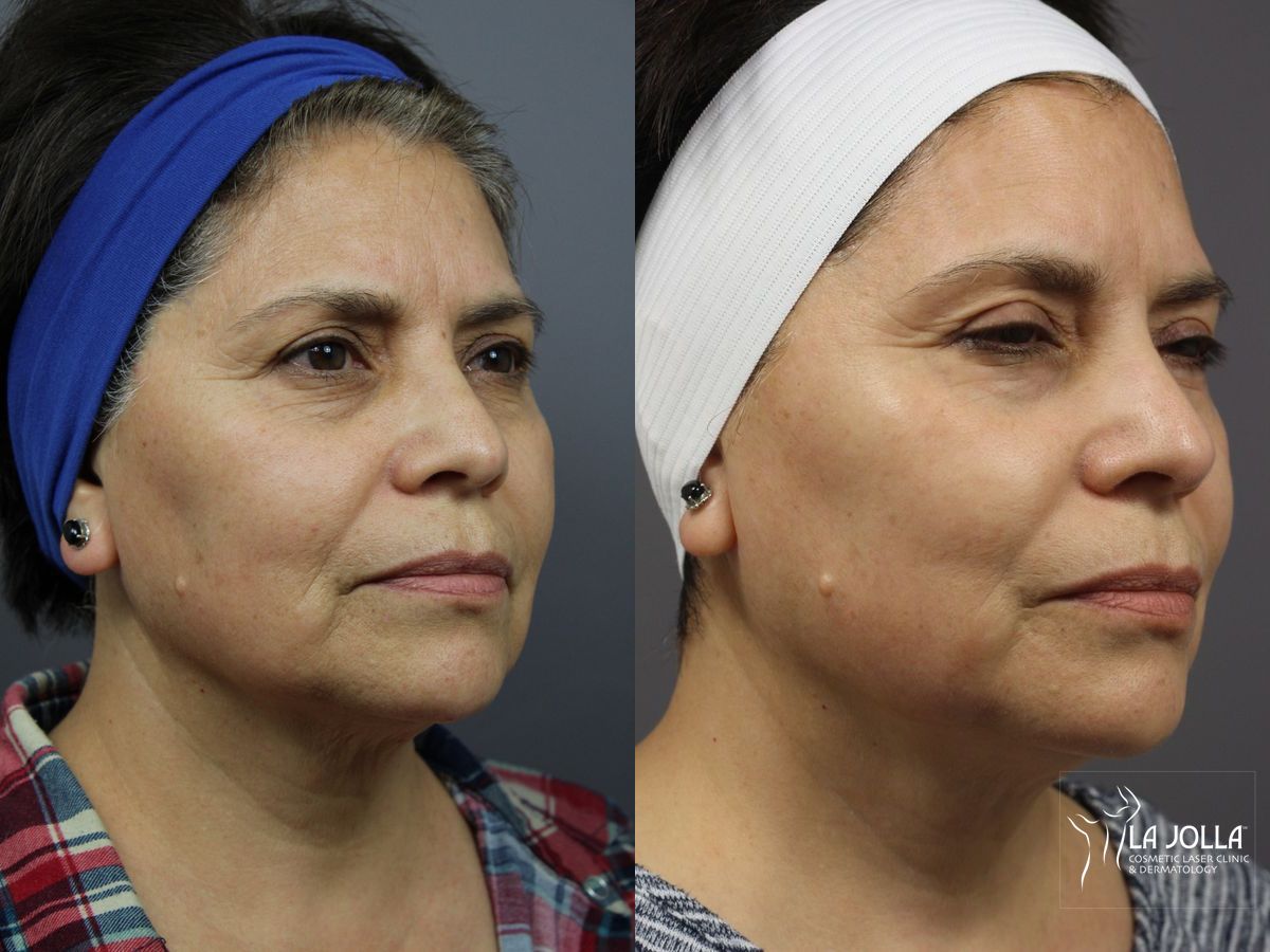 Before and after SP Dynamis case 36357