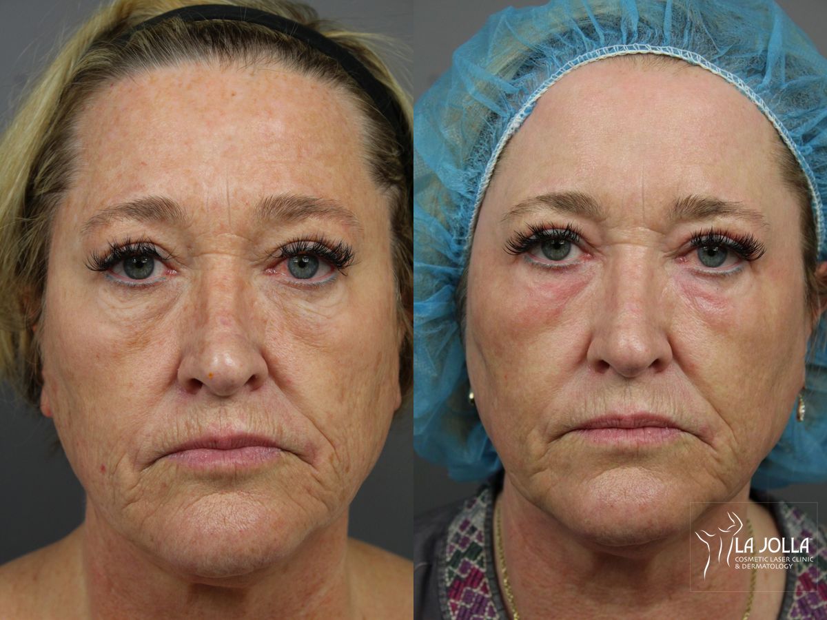 Before and after SP Dynamis case 36335