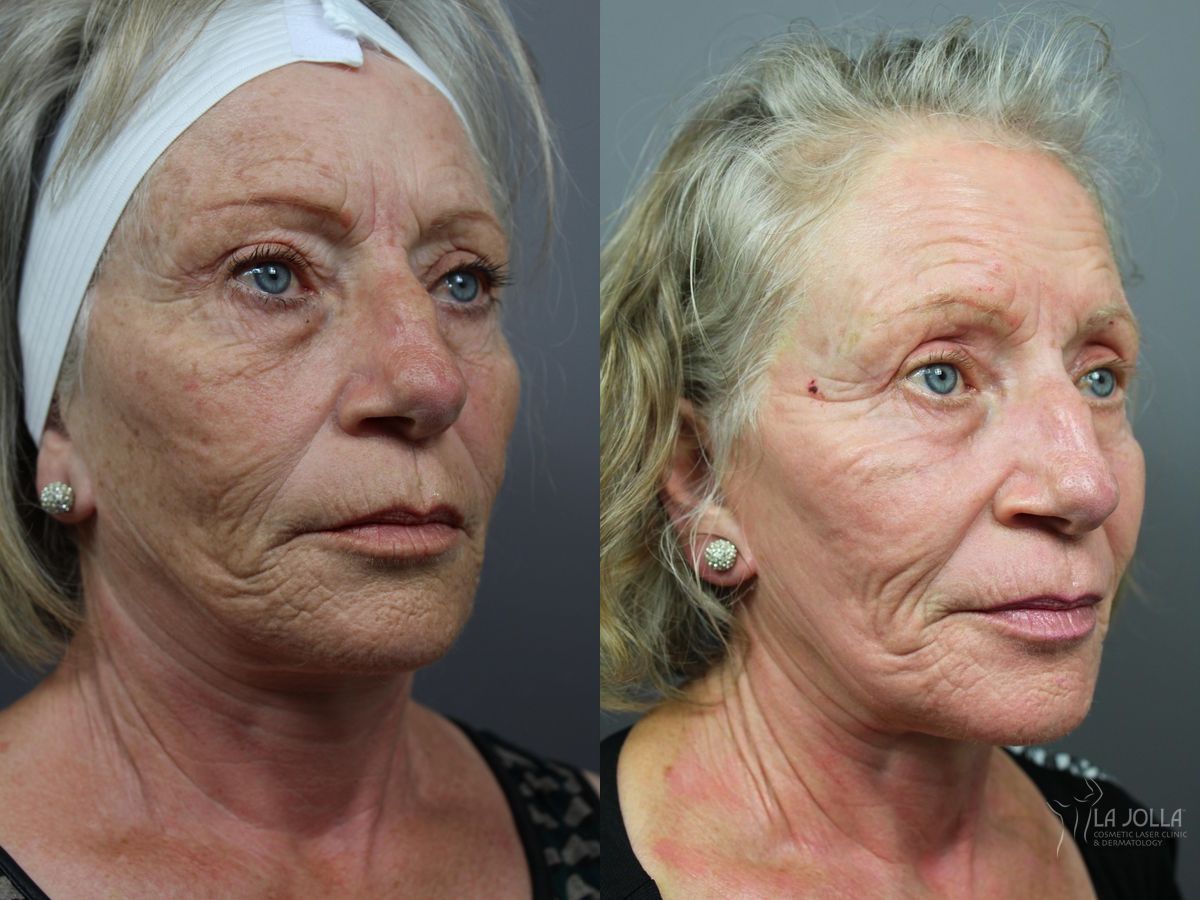 Before and after SP Dynamis case 36305