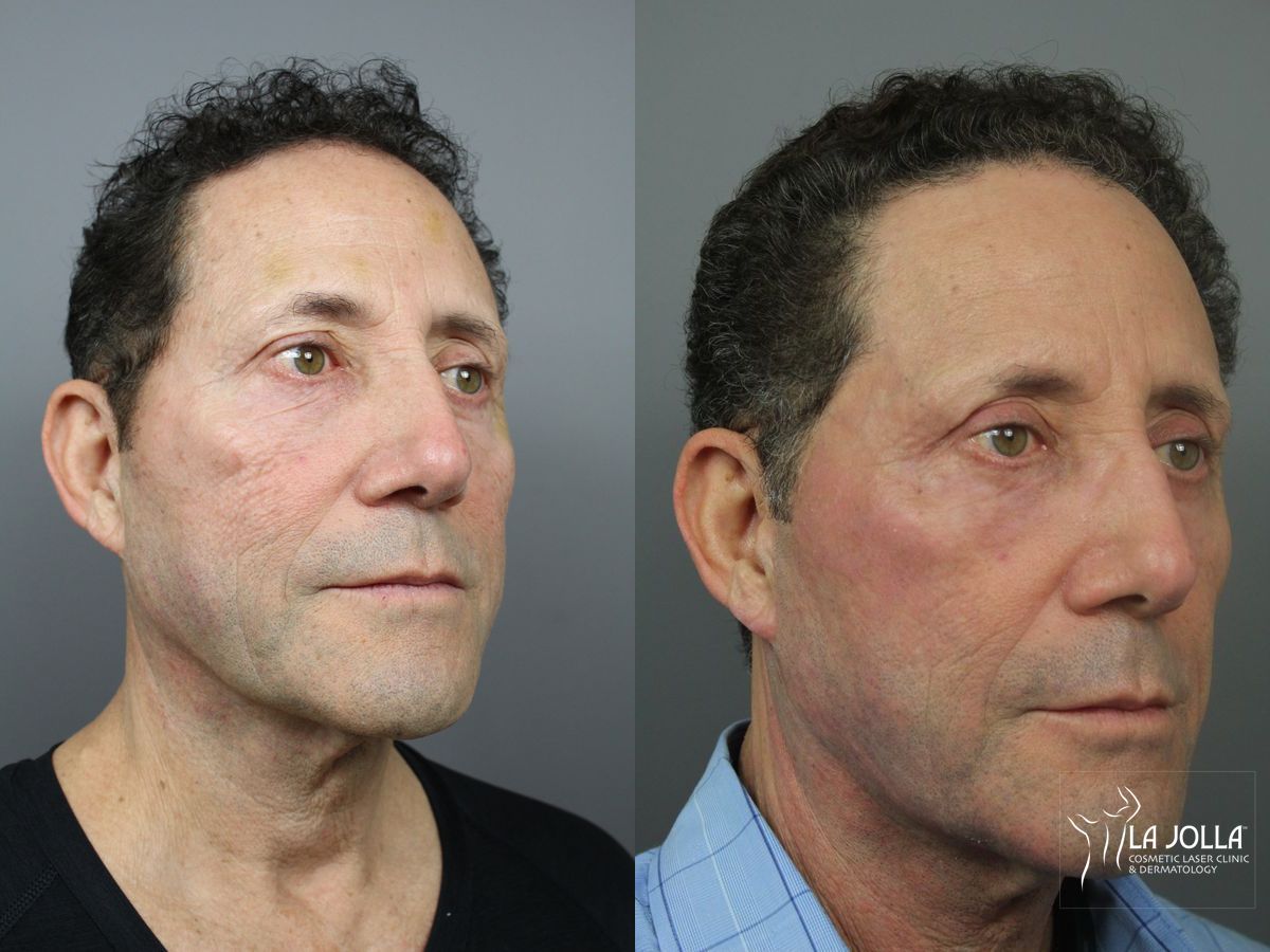 Before and after SP Dynamis case 36325