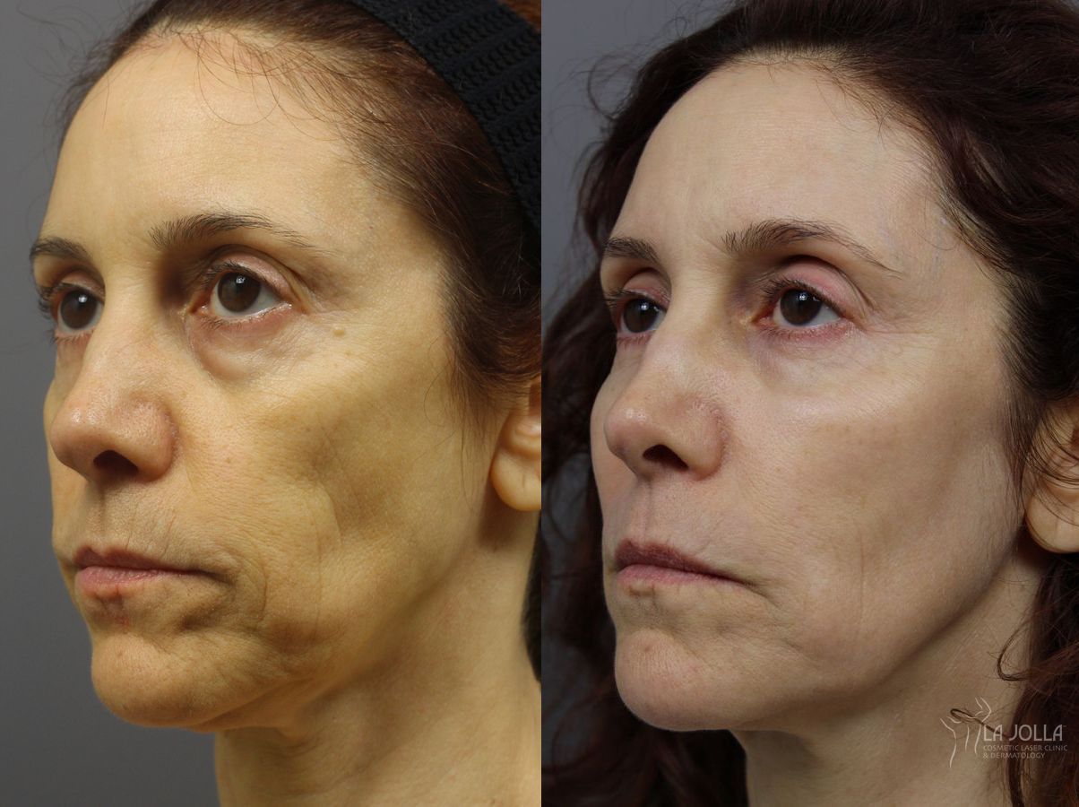 Before and after SP Dynamis case 36218