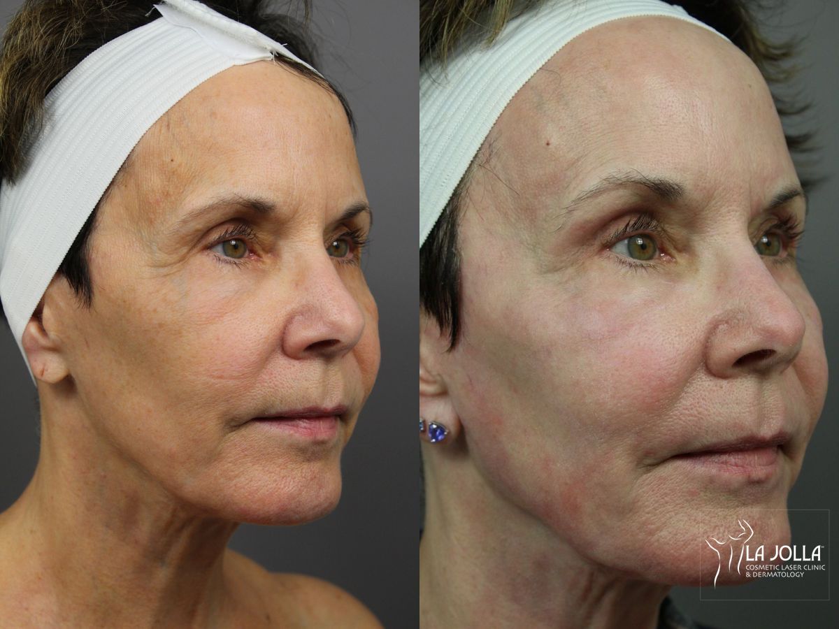 Before and after SP Dynamis case 36351