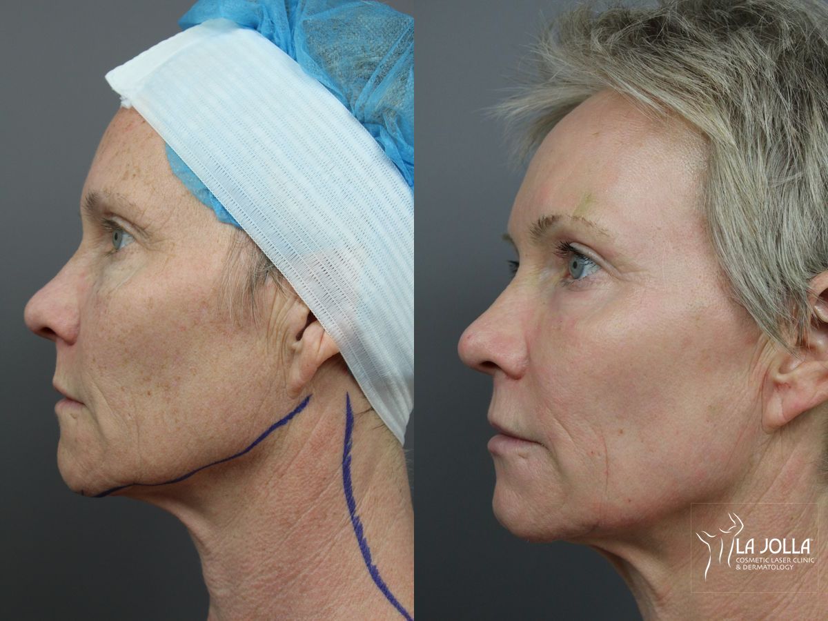 Before and after SP Dynamis case 36374