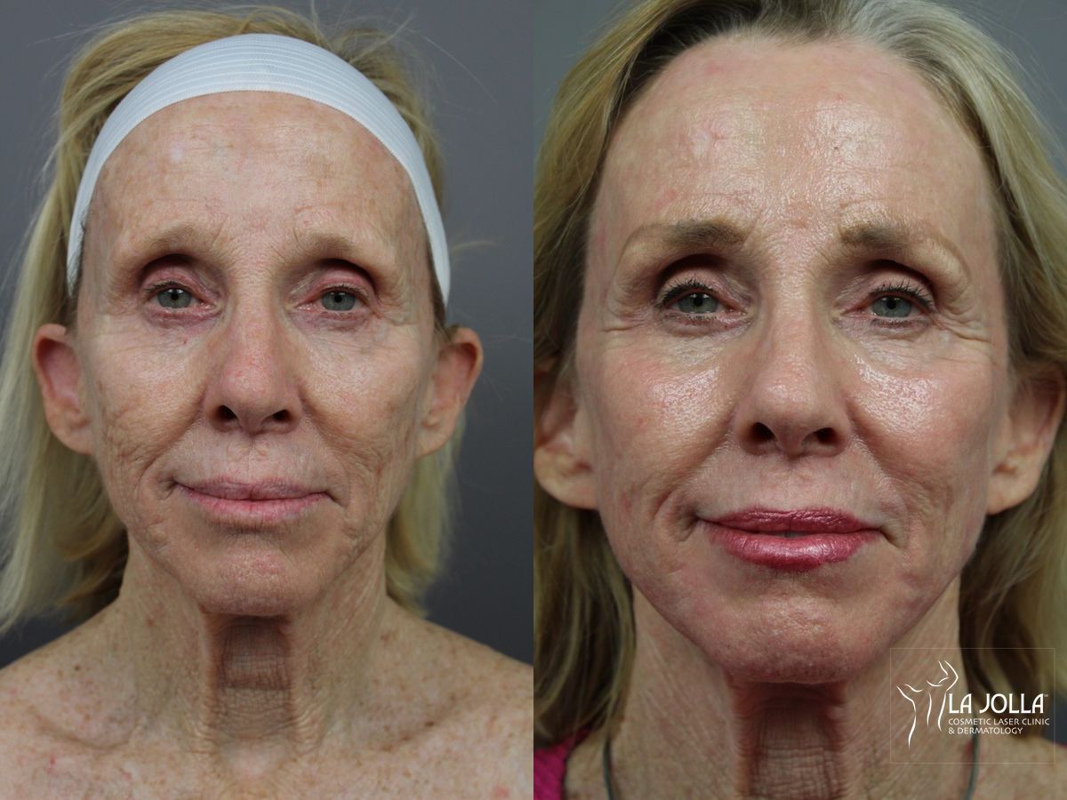 Before and after SP Dynamis case 36378