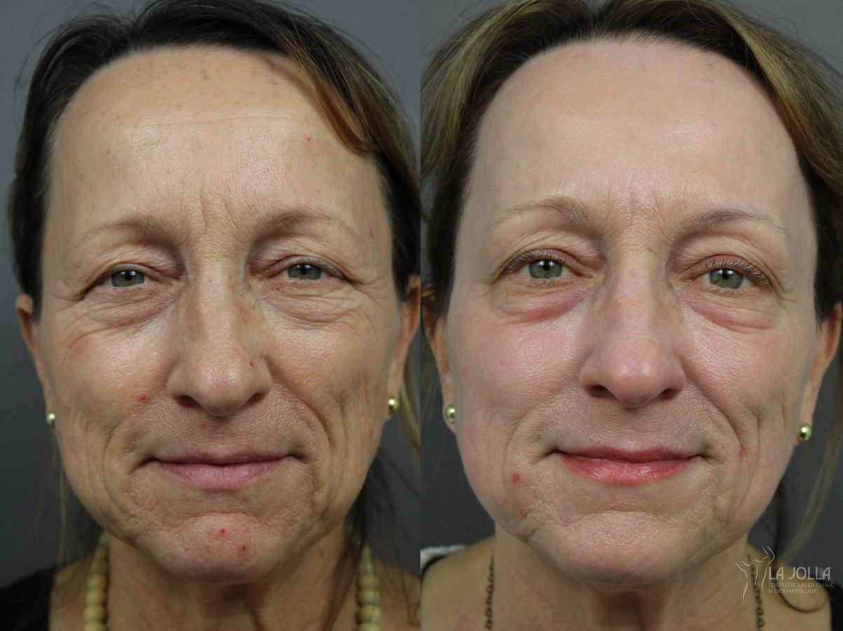 Before and after SP Dynamis case 36168
