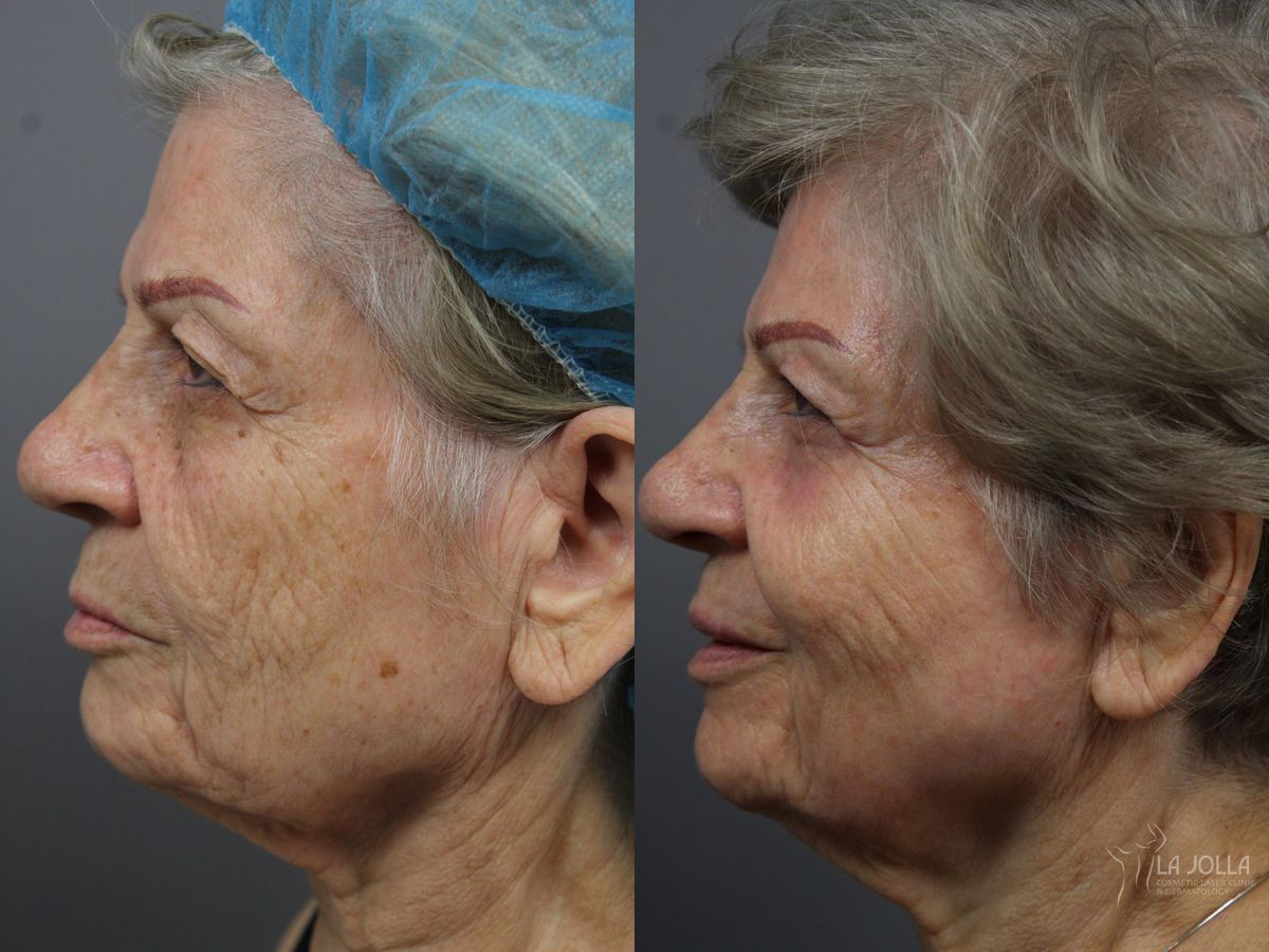 Before and after SP Dynamis case 36368