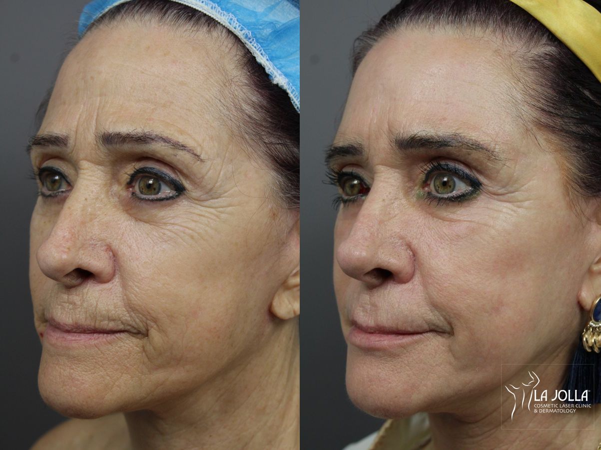 Before and after SP Dynamis case 36156 - Angle 2