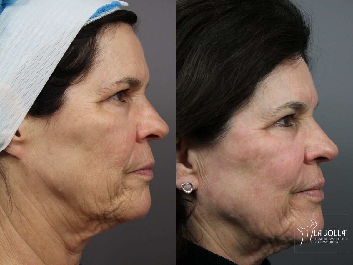 Before and after SP Dynamis case 36373