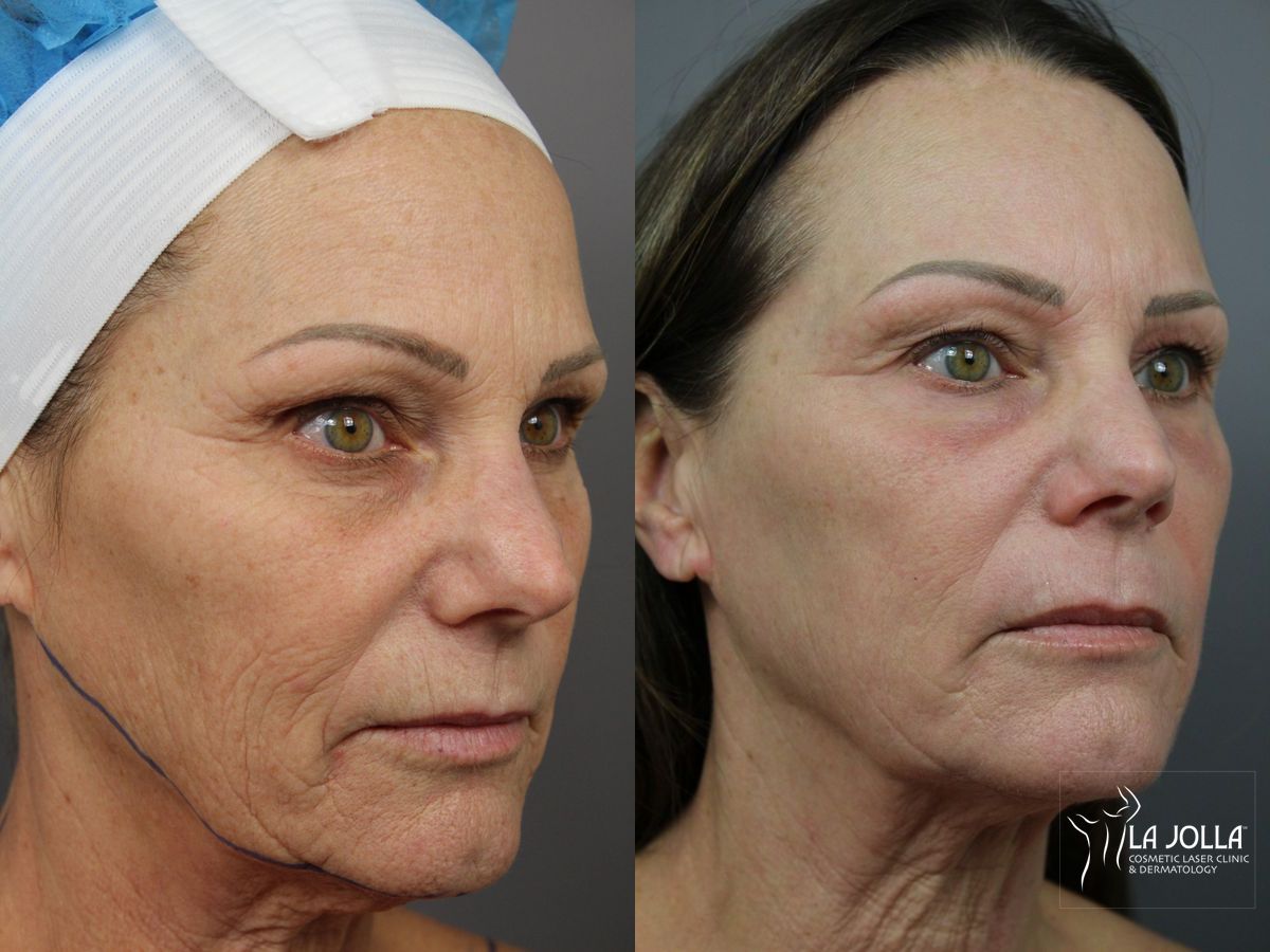 Before and after SP Dynamis case 36359