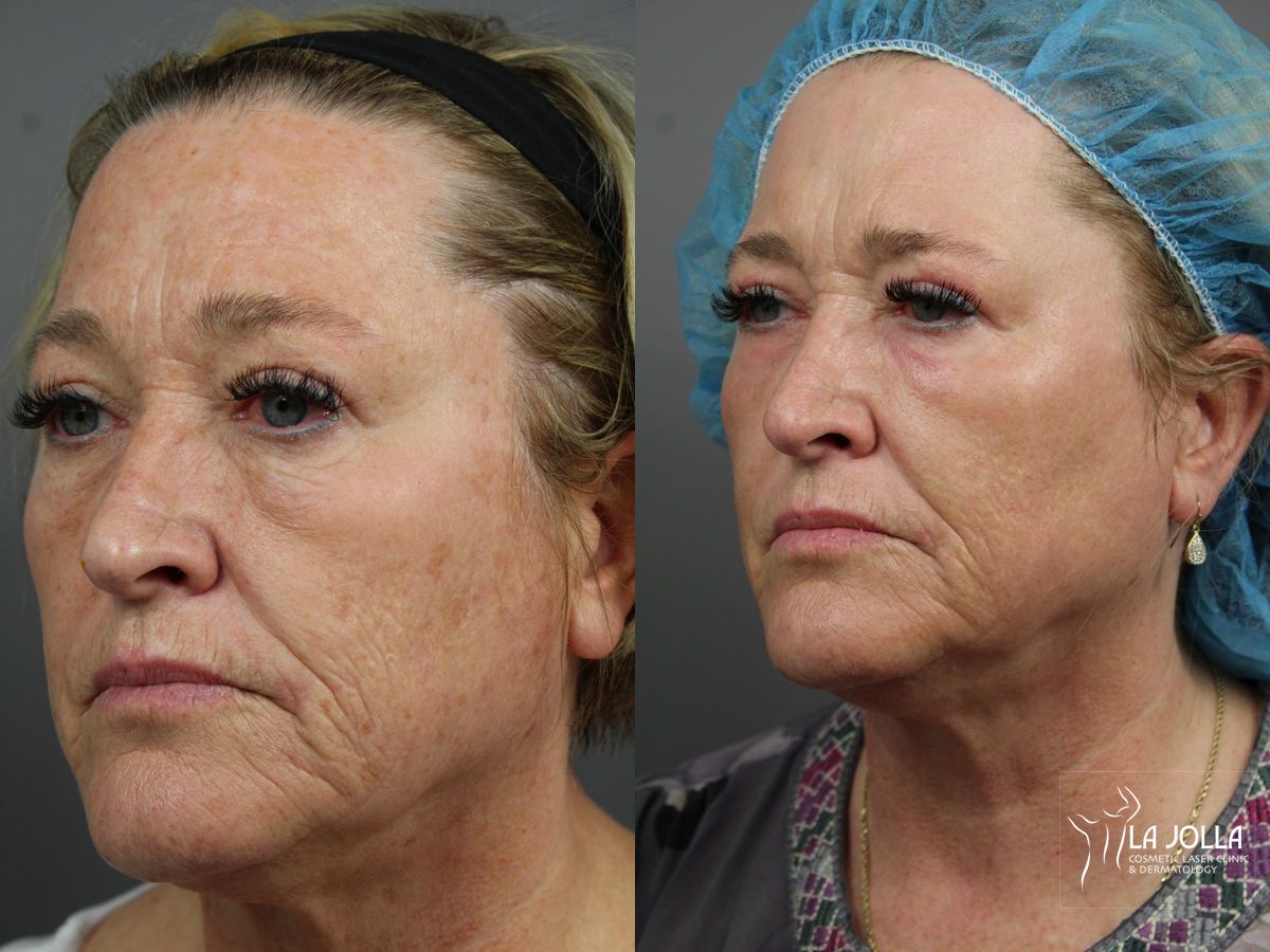 Before and after SP Dynamis case 36340