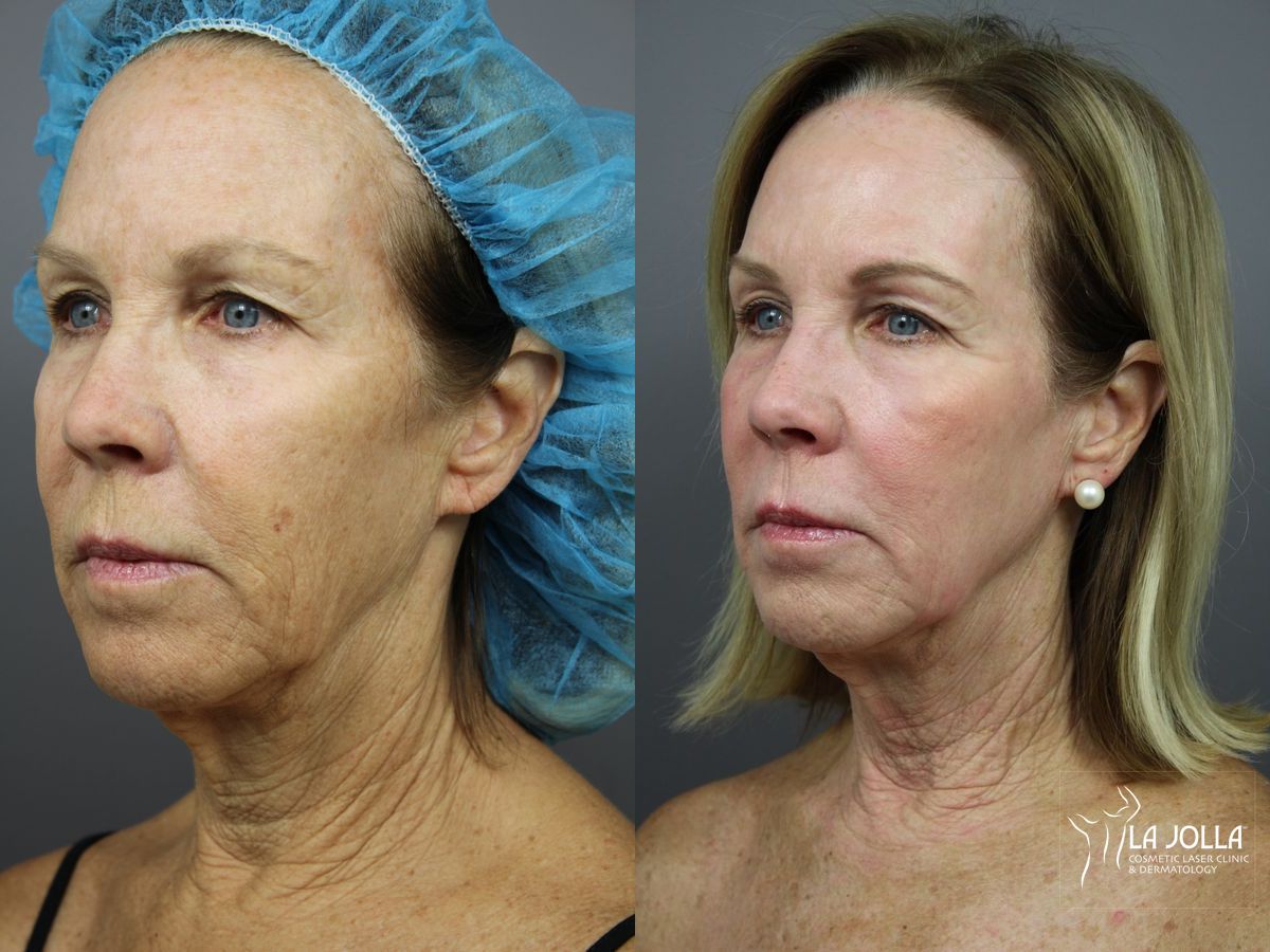 Before and after SP Dynamis case 36345