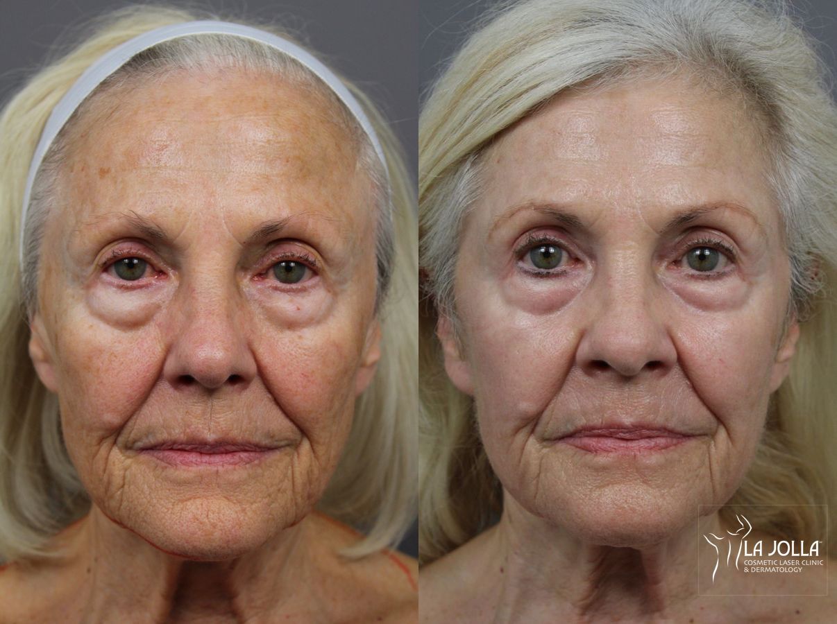 Before and after SP Dynamis case 36275