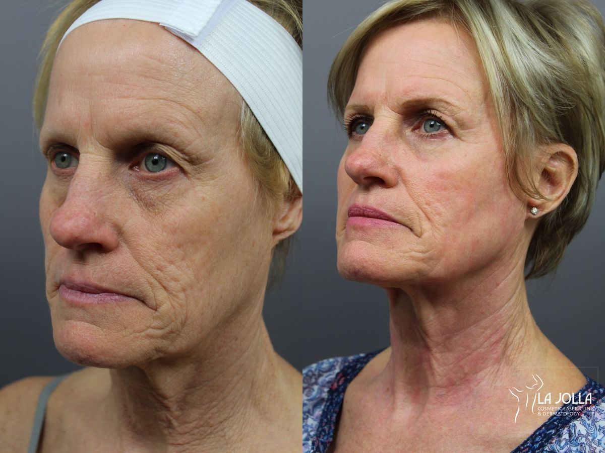 Before and after SP Dynamis case 36311