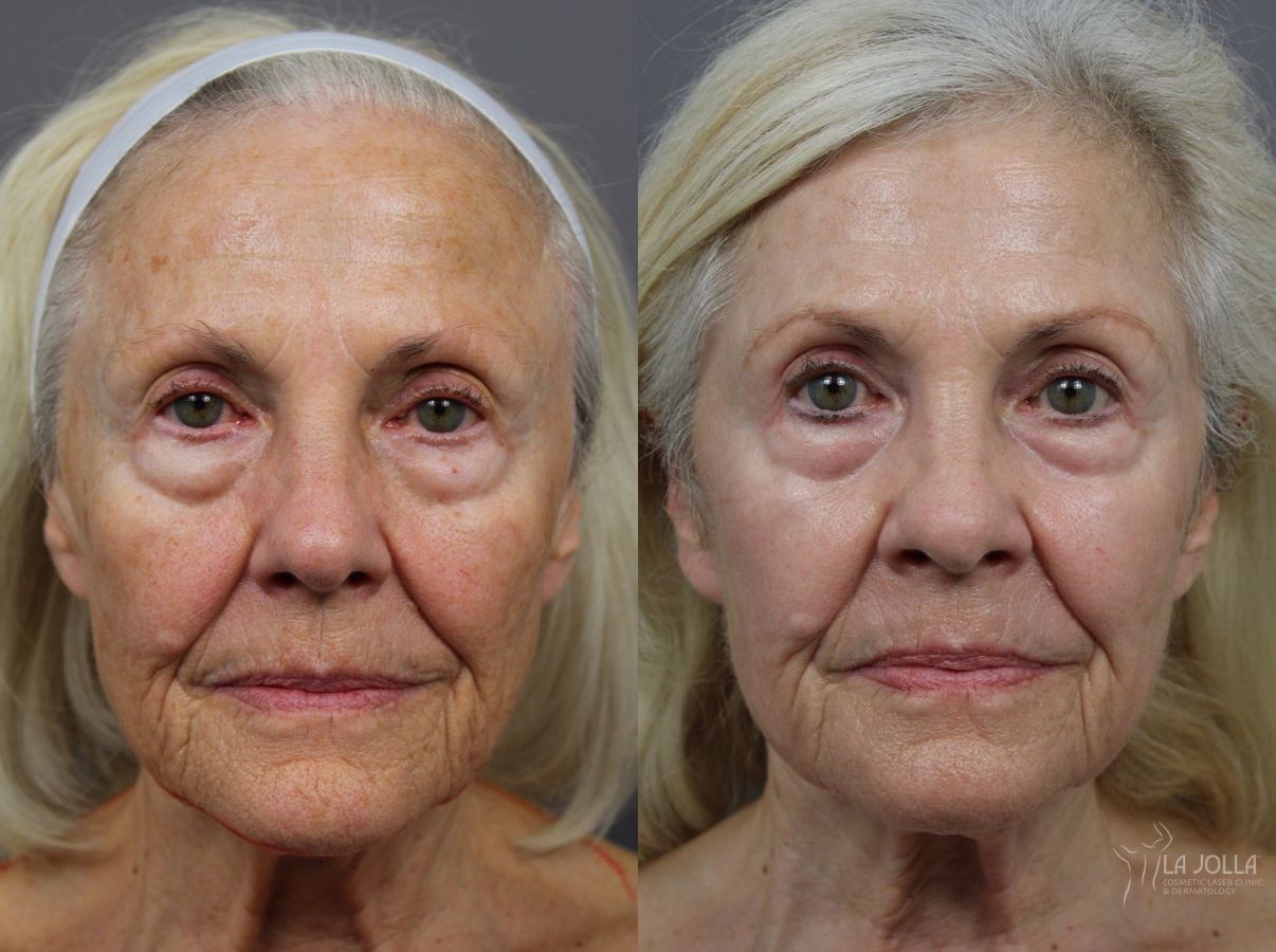 Before and after SP Dynamis case 36275